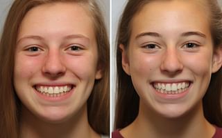Can braces correct an overbite?